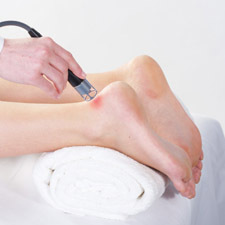 Laser therapy appllication. Achilles tendonitis.