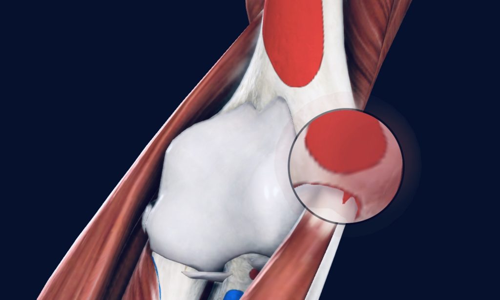 Check the best treatment for Golfer elbow syndrome