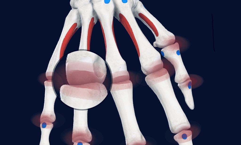 Rheumatoid arthritis is the most common type of autoimmune arthritis