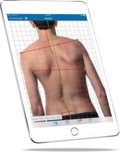 Picture Posture Screen of mobile app on cell phone. Scoliosis.