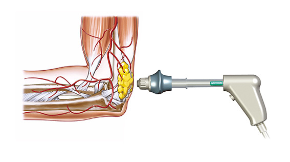 Shockwave Therapy SWT mechanism