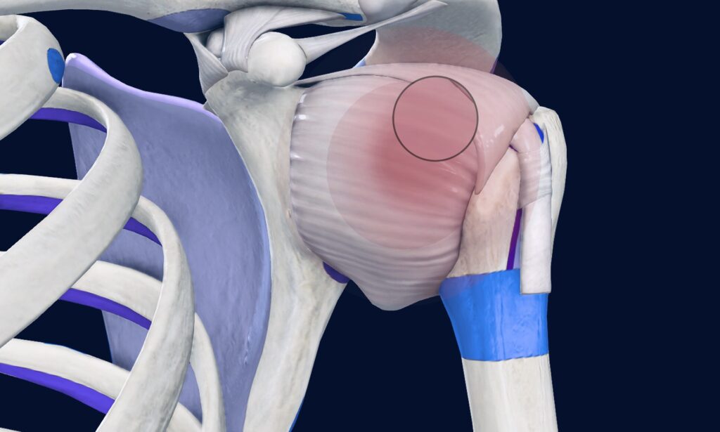 Article. Frozen shoulder.