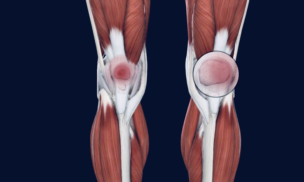 Patellofemoral syndrome is a pain in the front of the knee and around the kneecap