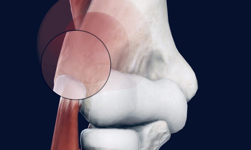 What caused tennis elbow and how long does it take to heal