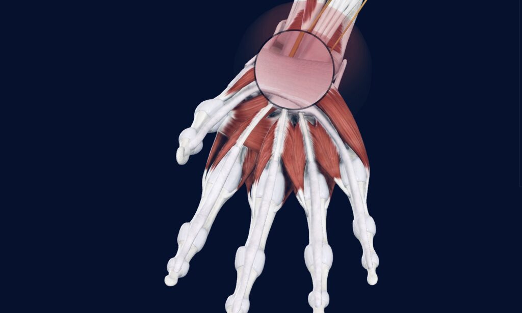 Carpal tunnel syndrome also called as median nerve compression