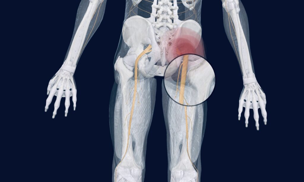 Sciatica causes and treatment