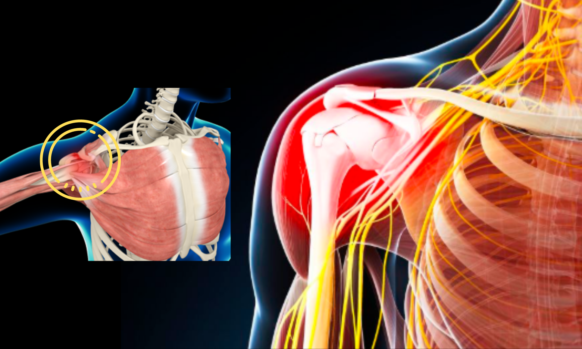 Shoulder Impingement Syndrome Osteo Health Osteopath Clinic In Calgary ...