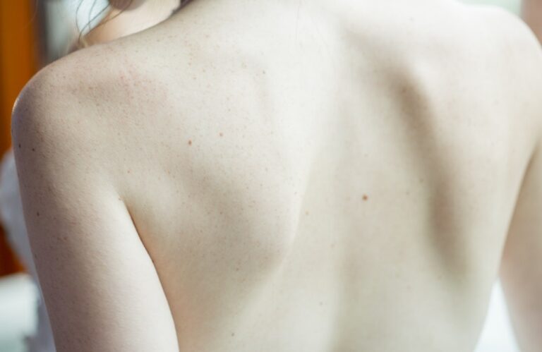 frozen shoulder osteopathy