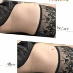 Brazilian Lymphatic Drainage in Calgary