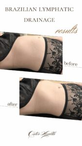 Brazilian Lymphatic Drainage in Calgary