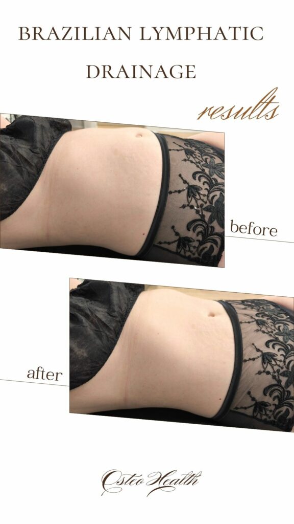 Brazilian Lymphatic Drainage in Calgary