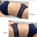 Lymphatic_drainage_before_and_after_2K_20261007174714