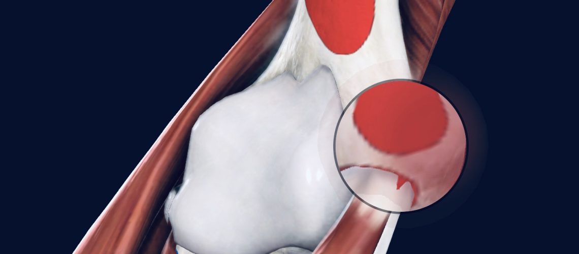 Check the best treatment for Golfer elbow syndrome