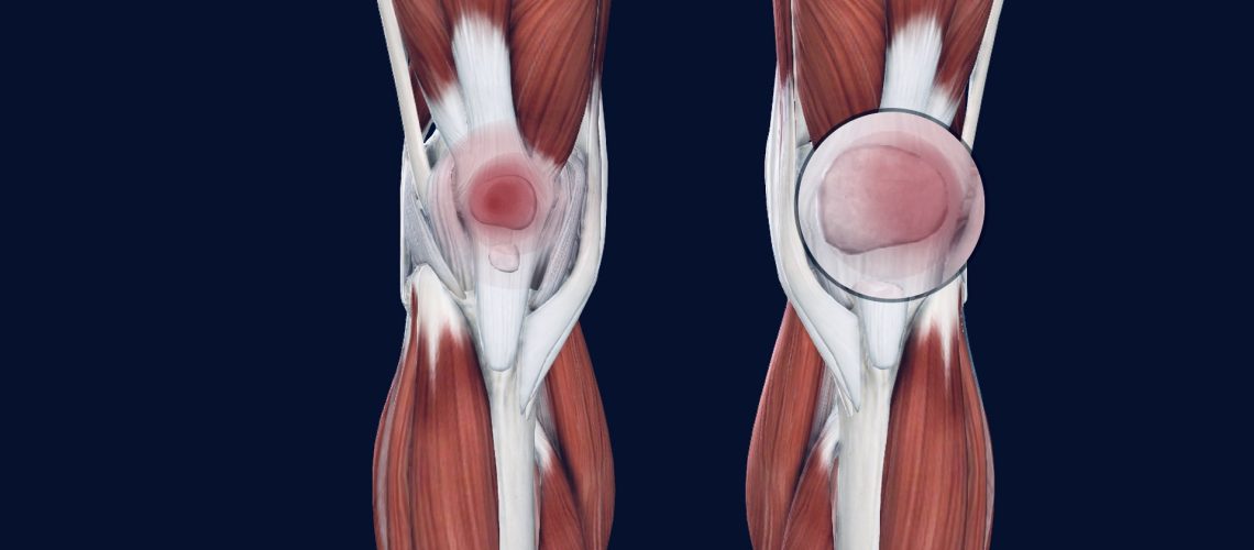 Patellofemoral syndrome is a pain in the front of the knee and around the kneecap