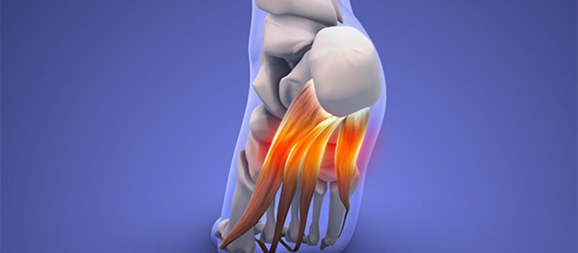 Plantar Fasciitis & Heel Spur Treatment Calgary (3)