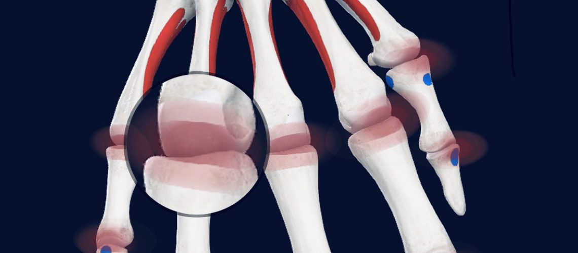 Rheumatoid arthritis is the most common type of autoimmune arthritis