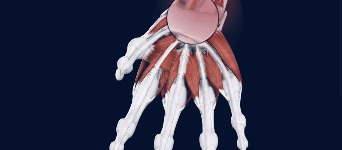Carpal tunnel syndrome also called as median nerve compression