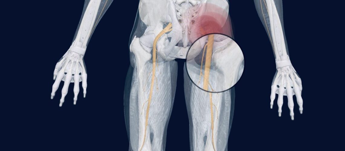 Sciatica causes and treatment