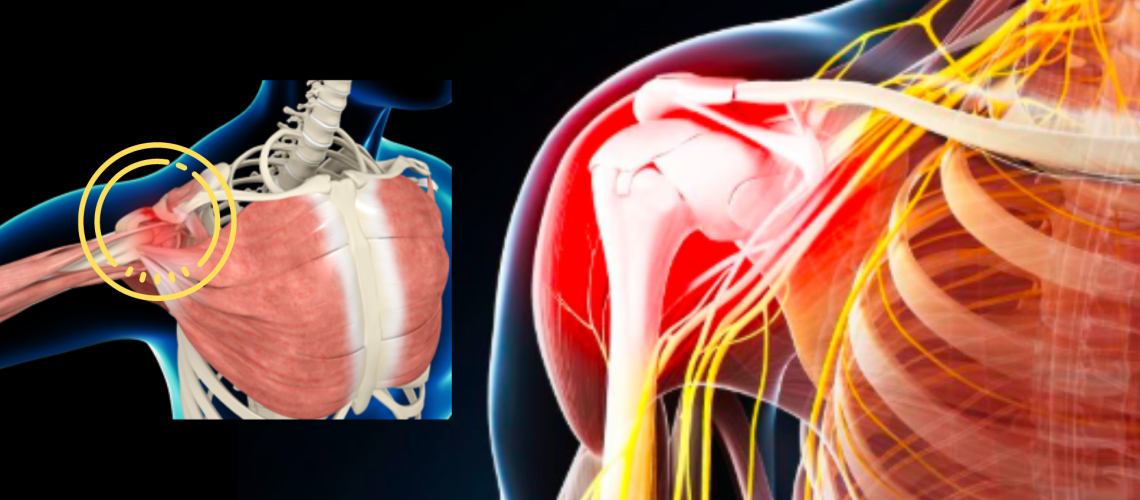 Shoulder impingement syndrome